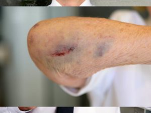 Common Soft Tissue Injuries and Conditions Contusions