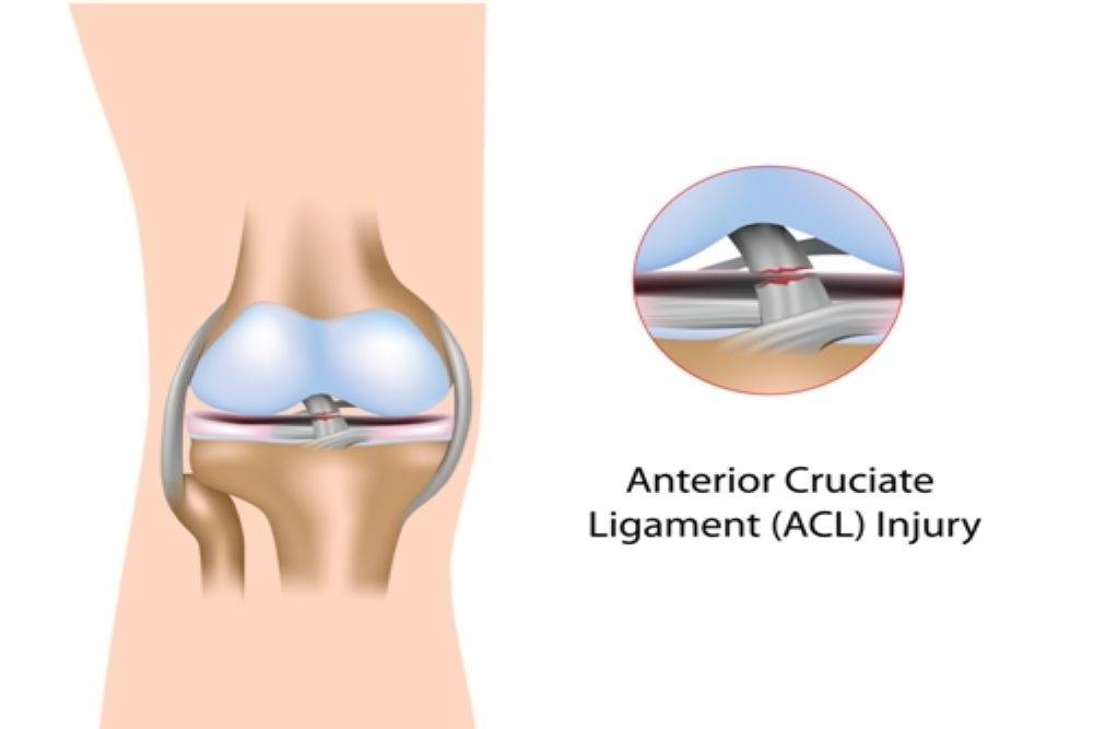 How Do You Know If You Tore Your ACL