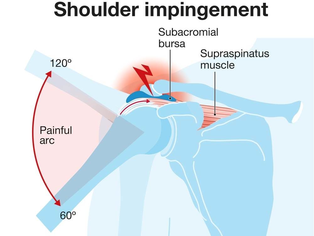 Treatment for Shoulder Impingement Syndrome