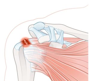 7 Signs of a Rotator Cuff Tear