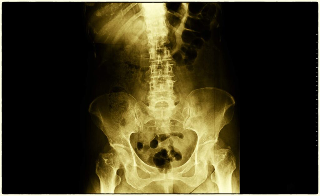 Sacral Fracture- Causes, Symptoms, and Treatments